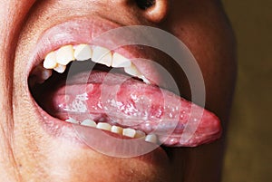 Acne on the tongue