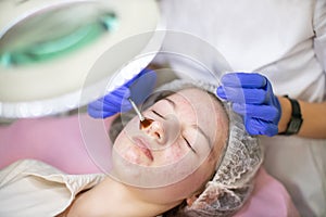 Acne treatment at modern professional cosmetologist& x27;s office. Top view of face of young teen girl with acne and post