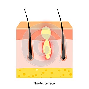 Acne treatment poster