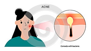 Acne treatment poster