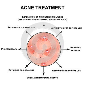 Acne treatment. Pustules, papules, comedones, blackheads, acne on the skin. Infographics. Vector illustration on