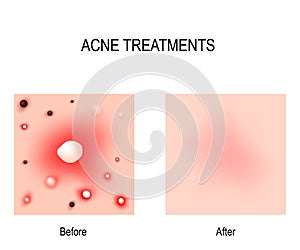 Acne Treatment. Before and after. Skin problems