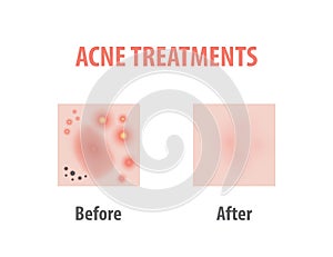 Acne treatments diagram illustration vector on white background, Beauty concept.