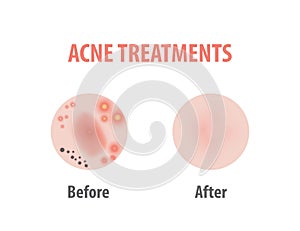 Acne treatments diagram illustration vector on white background, Beauty concept.