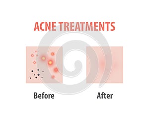 Acne treatments diagram illustration vector on white background, Beauty concept.