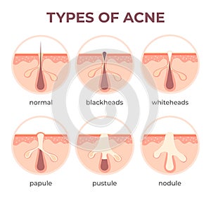 Acne types anatomy. Pimple diseases sectional view blackhead, cystic and whitehead. Structure of skin and pore infection