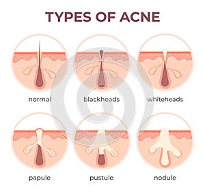 Acne types anatomy. Pimple diseases sectional view blackhead, cystic and whitehead. Structure of skin and pore infection photo
