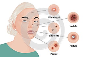 Acne types Cosmetology