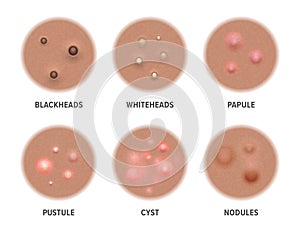 Acne types on dark skin, face pimples and comedones, vector blackheads and pore cysts. Skin acne types, cosmetology and skincare