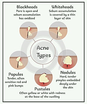 Acne types. Medical illustration. Infographic about skin and dermatology