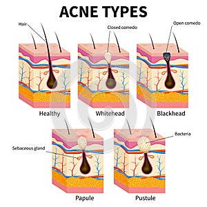 Acne types. Pimple skin diseases anatomy medical vector diagram