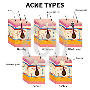 Acne types. Pimple skin diseases anatomy medical vector diagram photo