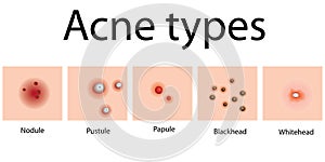 Acne types problem skin dermatology