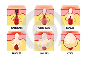 Acne types set. Skin disease, dermatology, cosmetology concept.