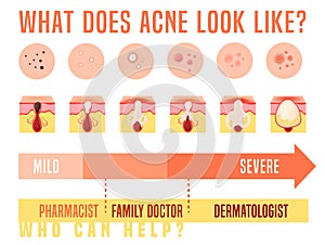 Acne types set. Skin disease, dermatology, cosmetology concept.