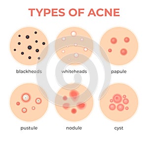 Acne types. Skin infection problem, pimples grade and type cyst, whitehead, blackheads, nodule and cystic. Dermis pore
