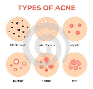 Acne types. Skin infection problem, pimples grade and type cyst, whitehead, blackheads, nodule and cystic. Dermis pore photo