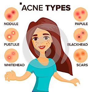 Acne Types Vector. Girl With Acne. Skin Care. Treatment, Healthy. Nodule, Whitehead. Isolated Flat Cartoon Character