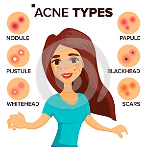 Acne Types Vector. Girl With Acne. Skin Care. Treatment, Healthy. Nodule, Whitehead. Isolated Flat Cartoon Character photo