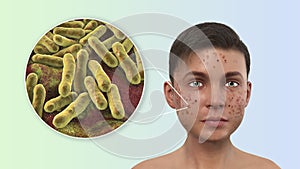 Acne vulgaris and bacteria Cutibacterium acnes