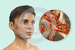 Acne vulgaris and bacteria Cutibacterium acnes