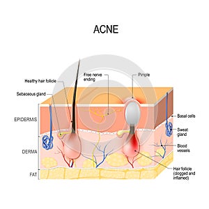 Acne vulgaris. pimple. photo