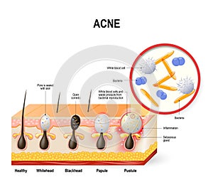 Acne vulgaris or pimple. photo