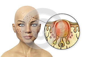 Acne vulgaris, white comedo, computer illustration photo