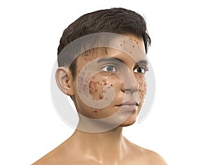 Acne vulgaris in a teenager boy
