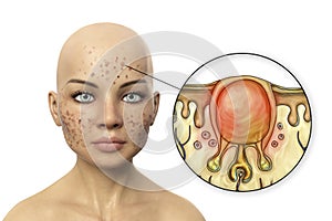 Acne vulgaris, white comedo, computer illustration