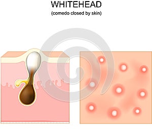 Acne. whitehead. Cross-section of a human skin with Hair follicle photo