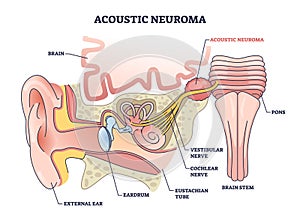Acoustic neuroma as benign tumor near vestibular nerve outline diagram photo