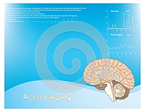 Acromegaly