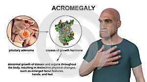 Acromegaly, 3D illustration