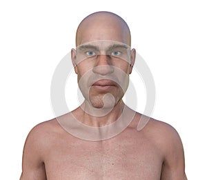 Acromegaly in a man, 3D illustration