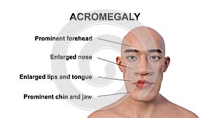 Acromegaly in a man, 3D illustration