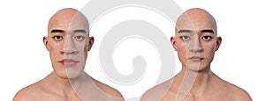 Acromegaly in a man, and the same healthy man, 3D illustration