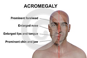 Acromegaly in a man, and the same healthy man, 3D illustration