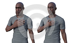 Acromegaly in a man, and the same healthy man for comparison, 3D illustration