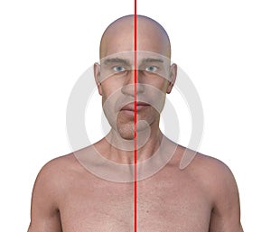 Acromegaly in a man, and the same healthy person, 3D illustration