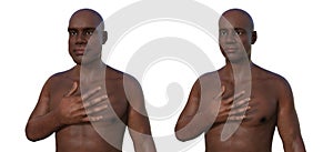 Acromegaly in a man, and the same healthy person, 3D illustration