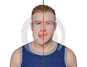 Acromegaly in a man, and the same healthy person, 3D illustration