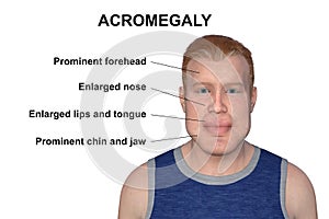 Acromegaly in a man, and the same healthy person, 3D illustration