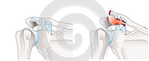 Acromioclavicular joint separation or AC joint separation or shoulder separation. Illustration