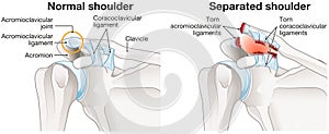 Acromioclavicular joint separation or AC joint separation or shoulder separation. Illustration