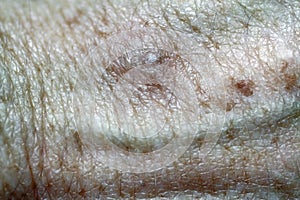 Actinic Keratoses