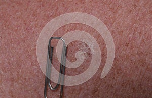 Actinic keratosis on human skin