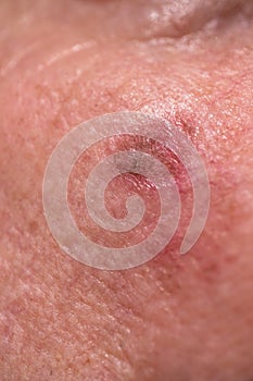 Actinic keratosis or sunspots on sun-damaged skin
