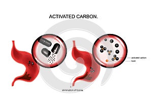 Action of activated carbon on toxins in the stomach