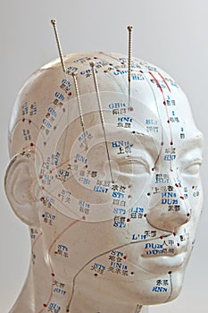 Acupuncture